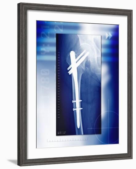 Pinned Broken Leg, X-ray-Miriam Maslo-Framed Photographic Print