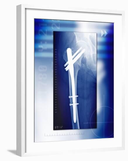 Pinned Broken Leg, X-ray-Miriam Maslo-Framed Photographic Print