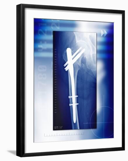 Pinned Broken Leg, X-ray-Miriam Maslo-Framed Photographic Print