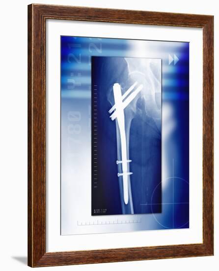 Pinned Broken Leg, X-ray-Miriam Maslo-Framed Photographic Print