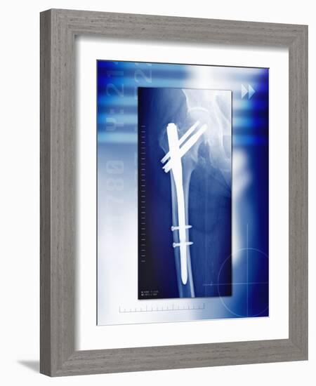 Pinned Broken Leg, X-ray-Miriam Maslo-Framed Photographic Print