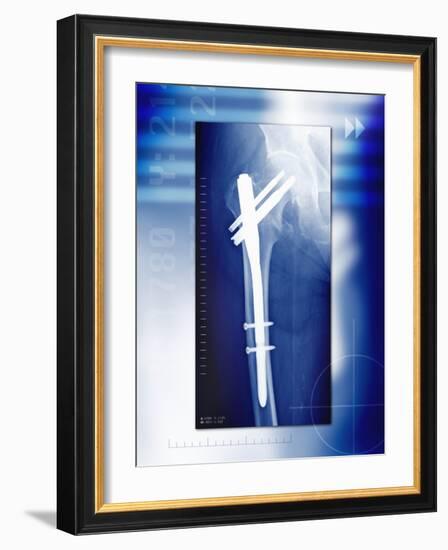 Pinned Broken Leg, X-ray-Miriam Maslo-Framed Photographic Print