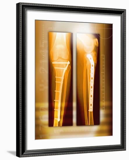Pinned Broken Leg, X-rays-Miriam Maslo-Framed Photographic Print