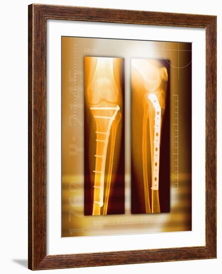 Pinned Broken Leg, X-rays-Miriam Maslo-Framed Photographic Print