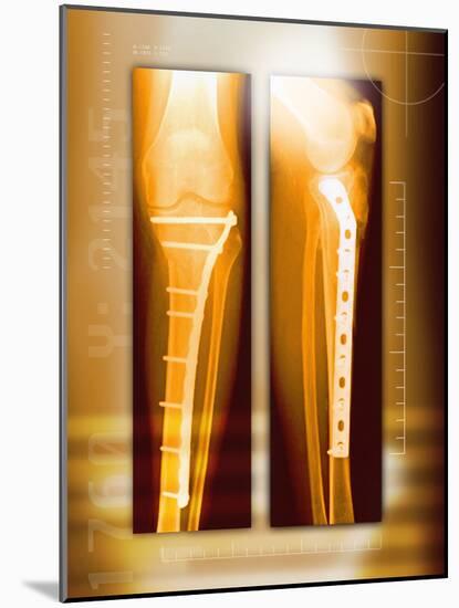 Pinned Broken Leg, X-rays-Miriam Maslo-Mounted Photographic Print
