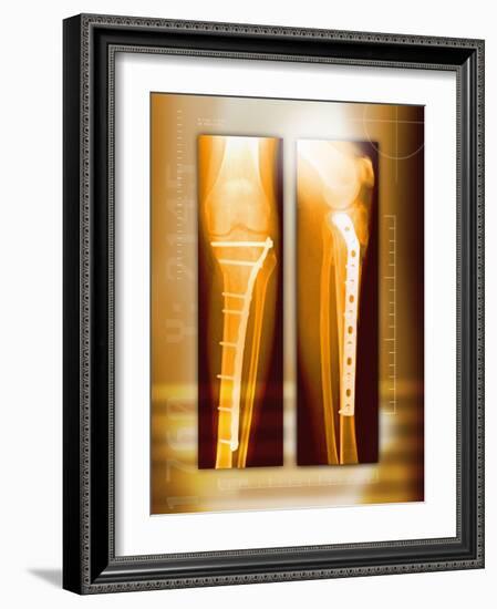 Pinned Broken Leg, X-rays-Miriam Maslo-Framed Photographic Print