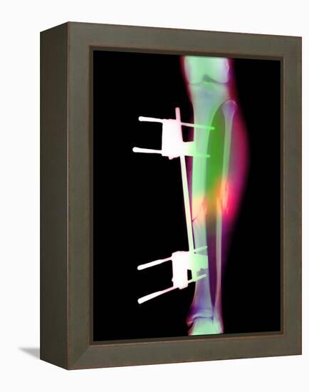 Pinned Broken Leg-Science Photo Library-Framed Premier Image Canvas