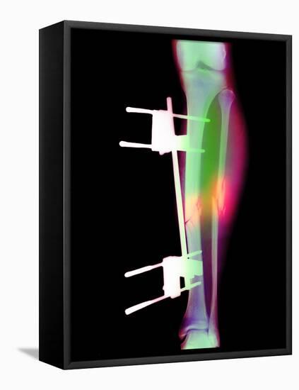 Pinned Broken Leg-Science Photo Library-Framed Premier Image Canvas