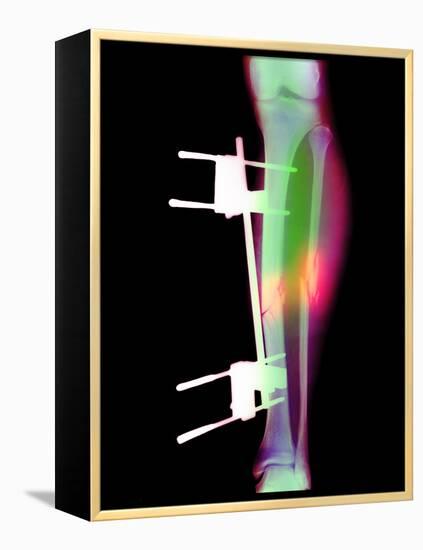 Pinned Broken Leg-Science Photo Library-Framed Premier Image Canvas