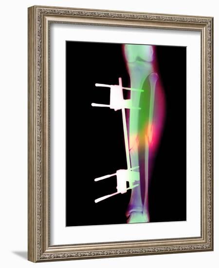 Pinned Broken Leg-Science Photo Library-Framed Photographic Print