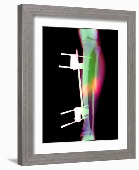 Pinned Broken Leg-Science Photo Library-Framed Photographic Print