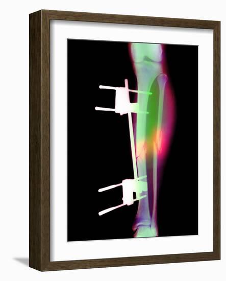 Pinned Broken Leg-Science Photo Library-Framed Photographic Print