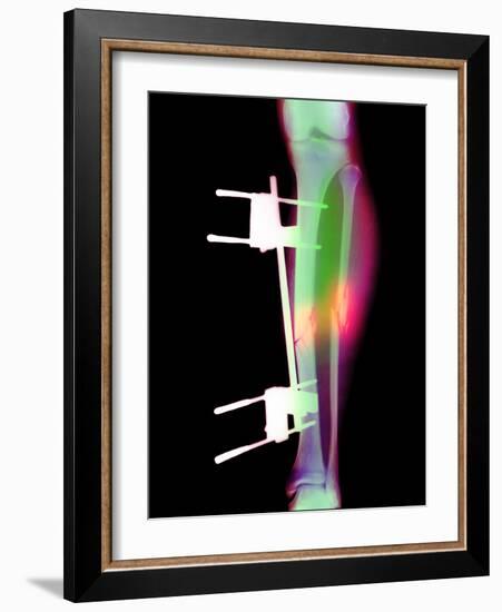 Pinned Broken Leg-Science Photo Library-Framed Photographic Print