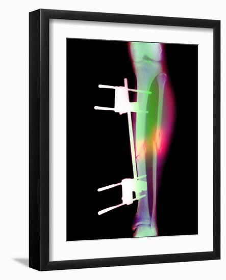 Pinned Broken Leg-Science Photo Library-Framed Photographic Print