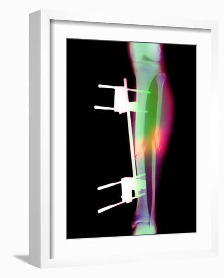 Pinned Broken Leg-Science Photo Library-Framed Photographic Print