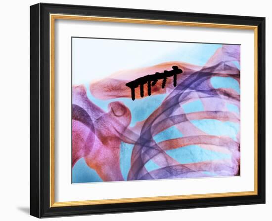 Pinned Collar Bone Fracture, X-ray-Science Photo Library-Framed Photographic Print