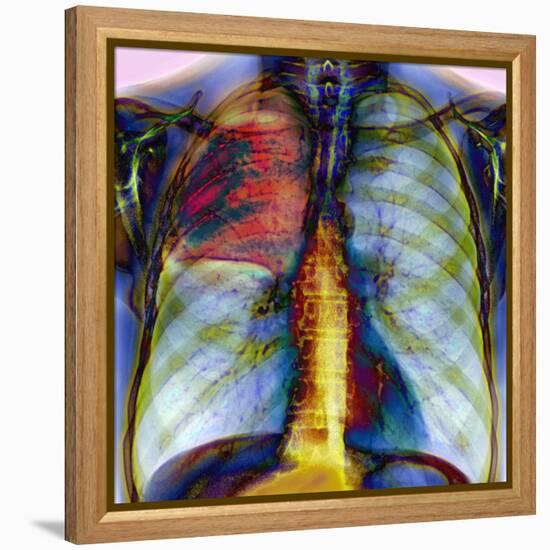 Pneumonia, X-ray-Du Cane Medical-Framed Premier Image Canvas