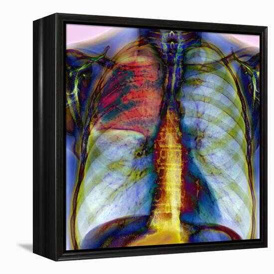Pneumonia, X-ray-Du Cane Medical-Framed Premier Image Canvas