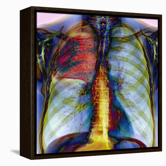 Pneumonia, X-ray-Du Cane Medical-Framed Premier Image Canvas