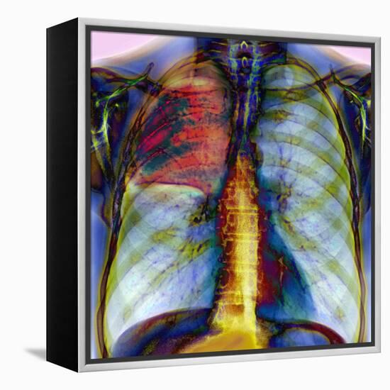 Pneumonia, X-ray-Du Cane Medical-Framed Premier Image Canvas