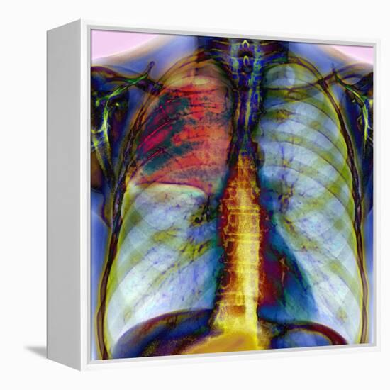 Pneumonia, X-ray-Du Cane Medical-Framed Premier Image Canvas