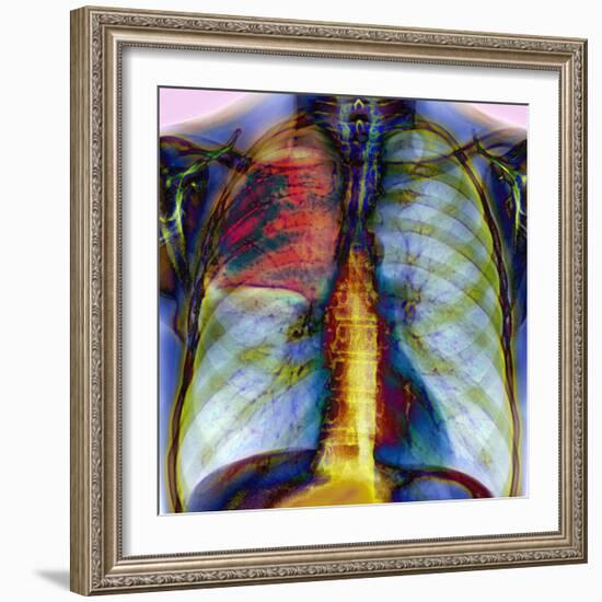 Pneumonia, X-ray-Du Cane Medical-Framed Premium Photographic Print