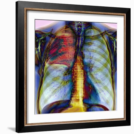 Pneumonia, X-ray-Du Cane Medical-Framed Premium Photographic Print