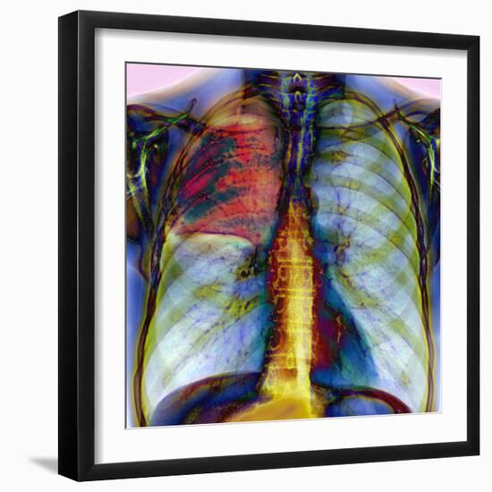 Pneumonia, X-ray-Du Cane Medical-Framed Premium Photographic Print