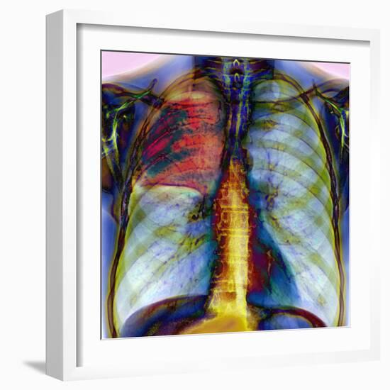 Pneumonia, X-ray-Du Cane Medical-Framed Premium Photographic Print