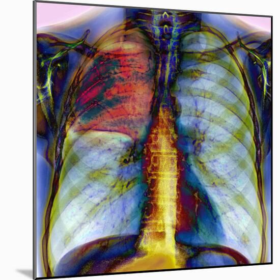 Pneumonia, X-ray-Du Cane Medical-Mounted Premium Photographic Print