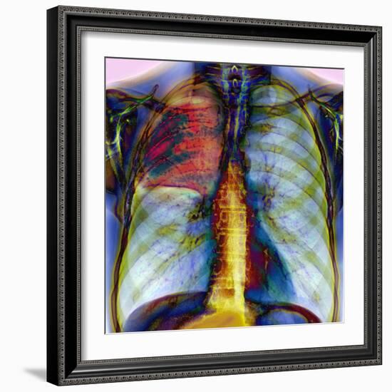 Pneumonia, X-ray-Du Cane Medical-Framed Premium Photographic Print