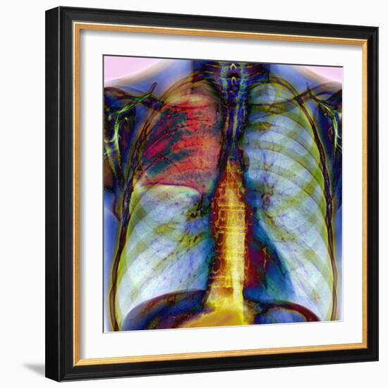 Pneumonia, X-ray-Du Cane Medical-Framed Premium Photographic Print