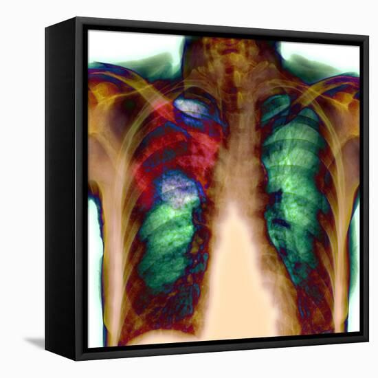 Pneumonia, X-ray-Du Cane Medical-Framed Premier Image Canvas