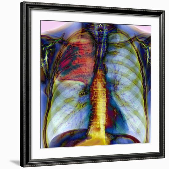 Pneumonia, X-ray-Du Cane Medical-Framed Photographic Print