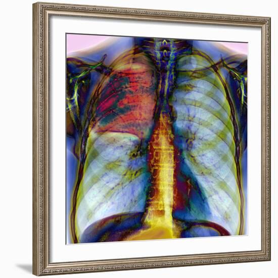 Pneumonia, X-ray-Du Cane Medical-Framed Photographic Print