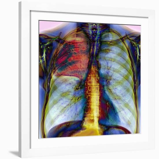 Pneumonia, X-ray-Du Cane Medical-Framed Photographic Print