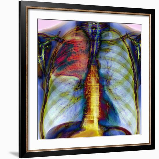 Pneumonia, X-ray-Du Cane Medical-Framed Photographic Print