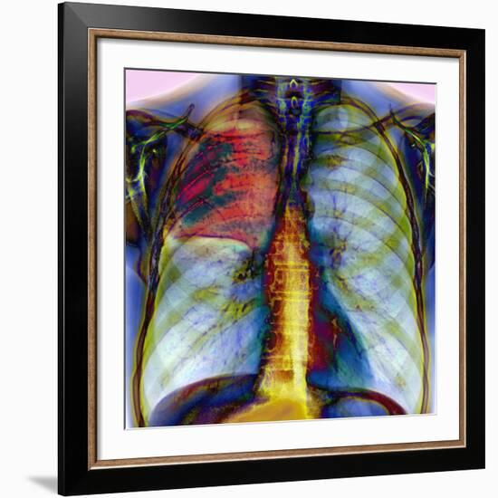 Pneumonia, X-ray-Du Cane Medical-Framed Photographic Print