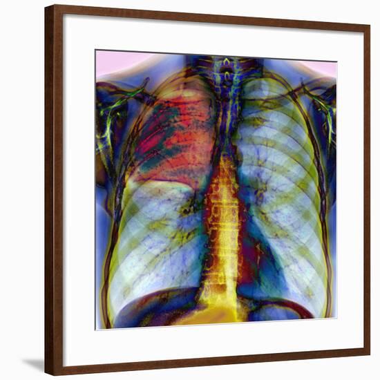 Pneumonia, X-ray-Du Cane Medical-Framed Photographic Print