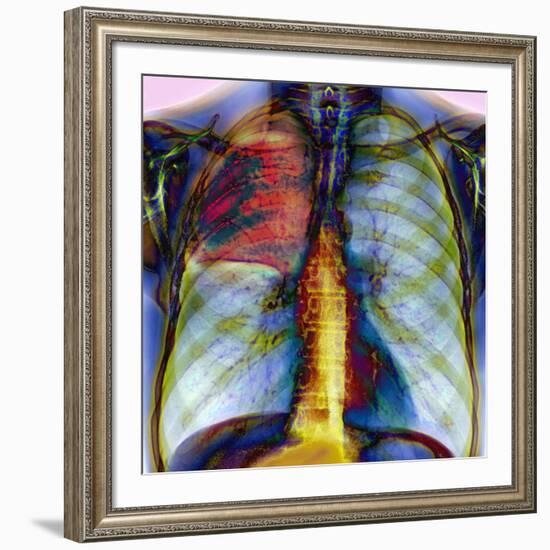 Pneumonia, X-ray-Du Cane Medical-Framed Photographic Print