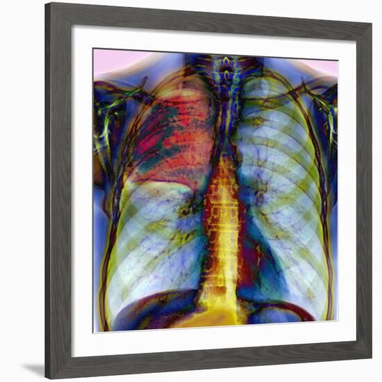 Pneumonia, X-ray-Du Cane Medical-Framed Photographic Print