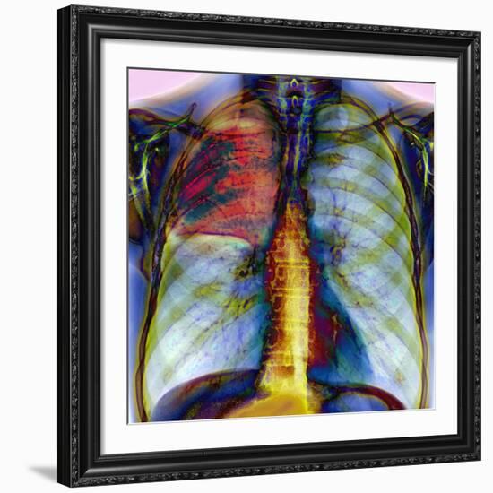 Pneumonia, X-ray-Du Cane Medical-Framed Photographic Print