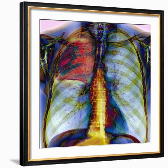 Pneumonia, X-ray-Du Cane Medical-Framed Photographic Print