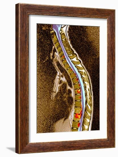 Pott's Disease-Du Cane Medical-Framed Photographic Print