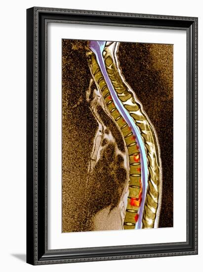 Pott's Disease-Du Cane Medical-Framed Photographic Print