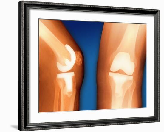 Prosthetic Knee Joint, Coloured X-ray-Miriam Maslo-Framed Photographic Print