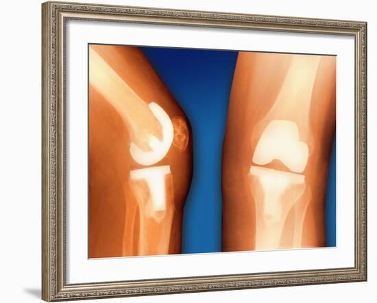 Prosthetic Knee Joint, Coloured X-ray-Miriam Maslo-Framed Photographic Print