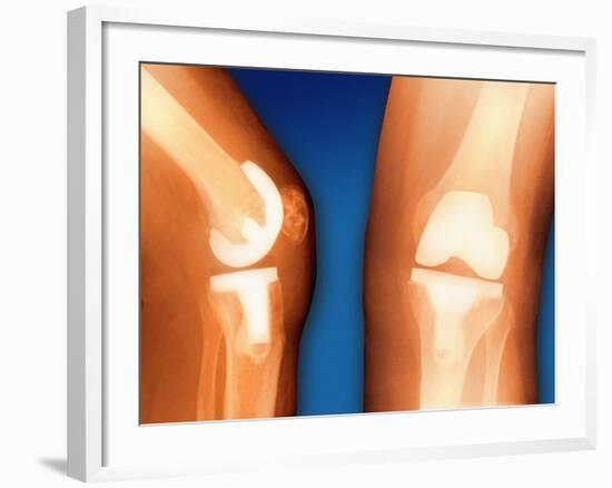 Prosthetic Knee Joint, Coloured X-ray-Miriam Maslo-Framed Photographic Print