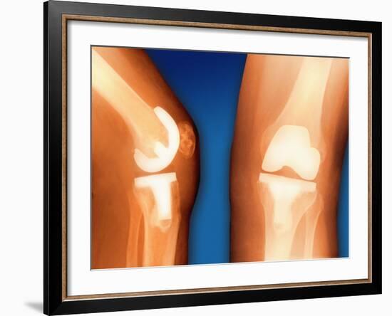 Prosthetic Knee Joint, Coloured X-ray-Miriam Maslo-Framed Photographic Print