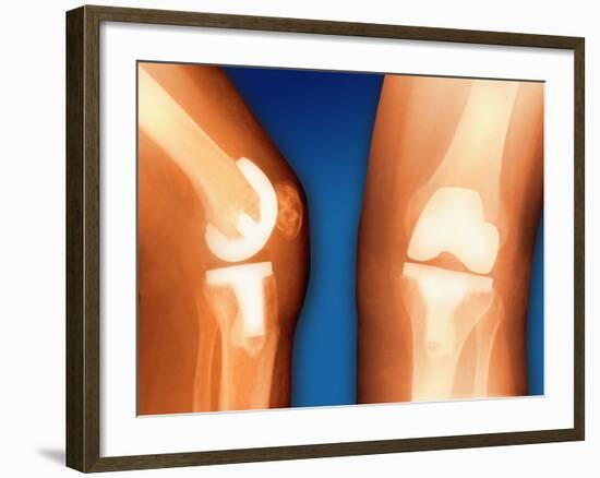 Prosthetic Knee Joint, Coloured X-ray-Miriam Maslo-Framed Photographic Print